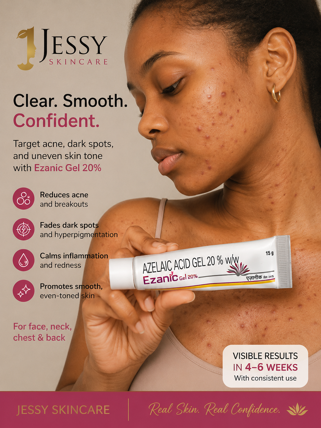 AZELAIC ACID FOR ACNE