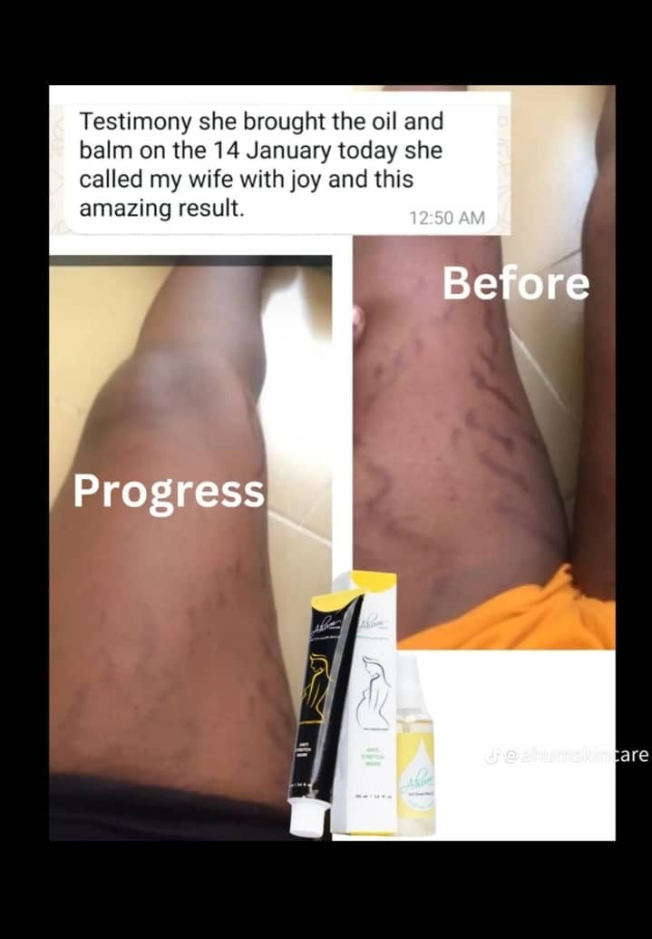 Ahum Stretch Mark Care Set