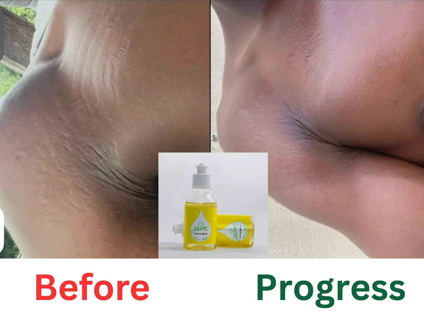 Ahum Stretch Mark Care Set