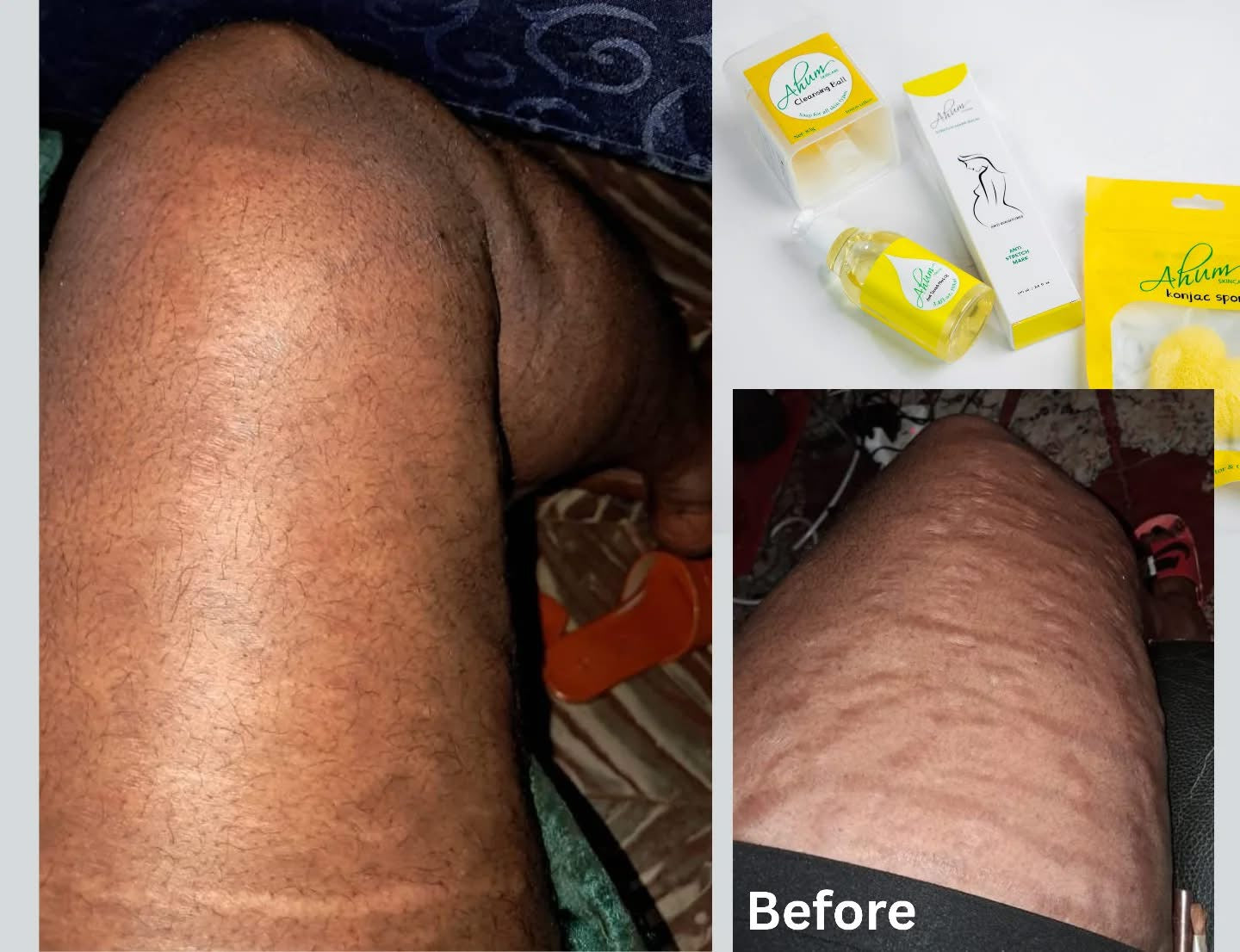 Ahum Stretch Mark Care Set