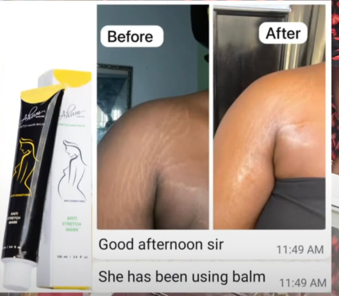 Ahum Stretch Mark Care Set