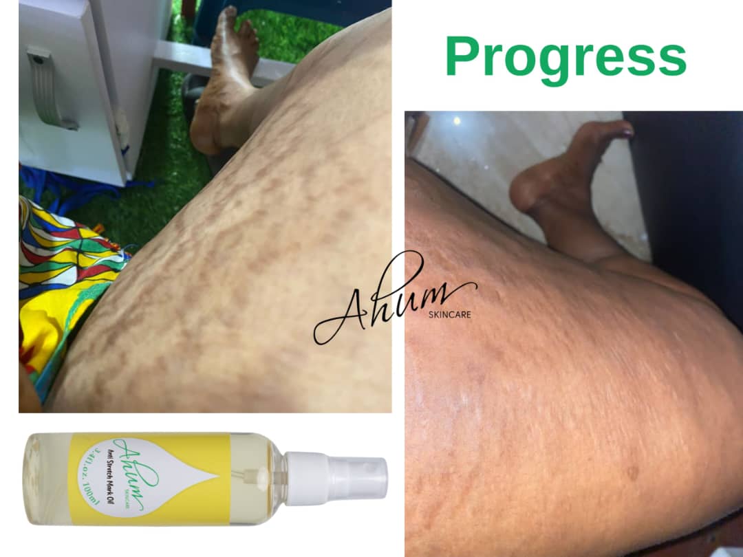 Ahum Stretch Mark Care Set