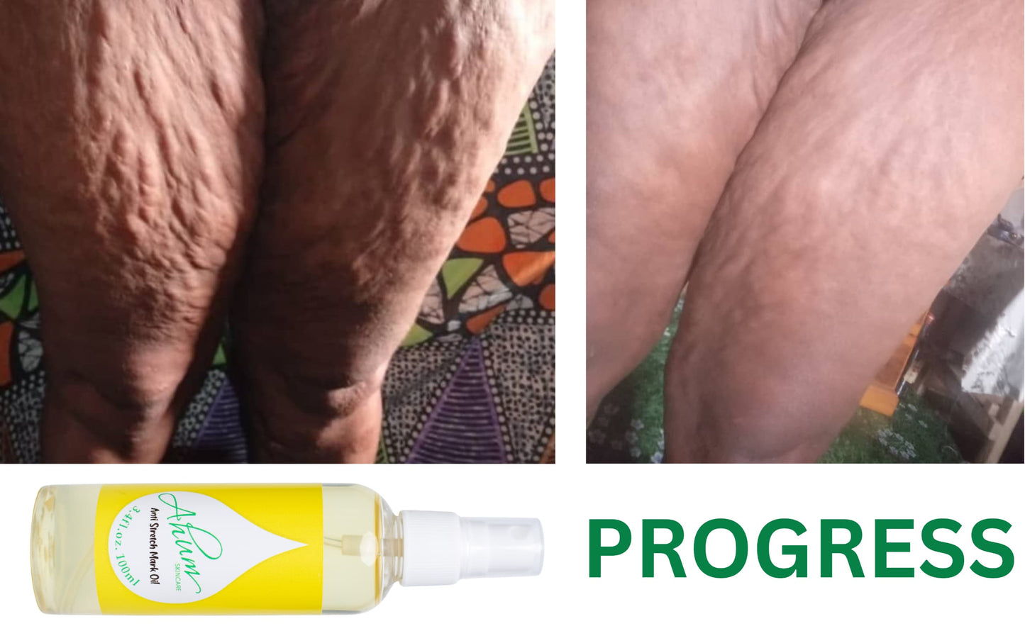 Ahum Stretch Mark Care Set