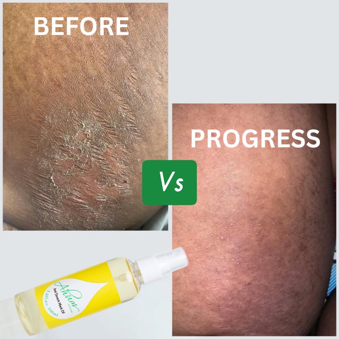 Ahum Stretch Mark Care Set